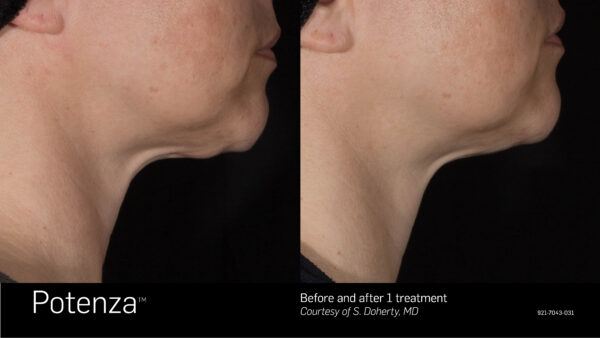 Potenza RF microneedling skin tightening on the neck