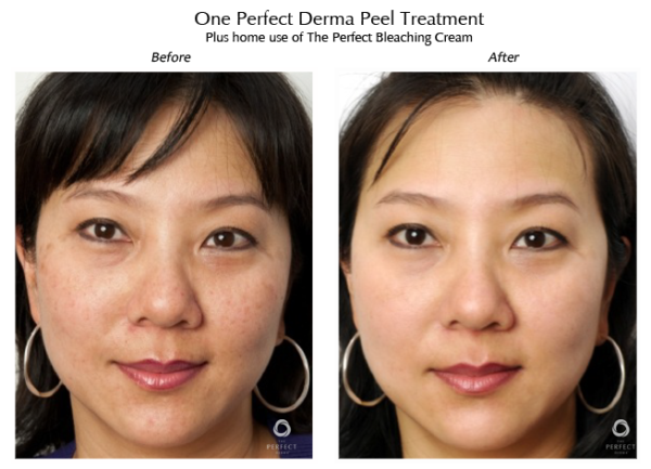 perfect derma peel before and after