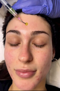 Woman receiving BioRePeelCl3 treatment